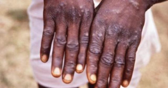  جدرى القرود