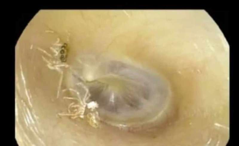 أطباء تايوانيون يزيلون عنكبوتًا صغيرًا من قناة أذن أمرأة
