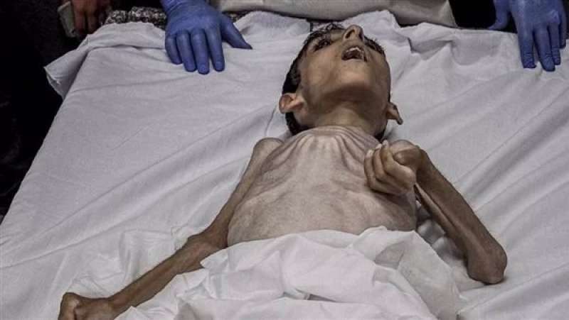أطفال غزة يموتون جوعاً 
