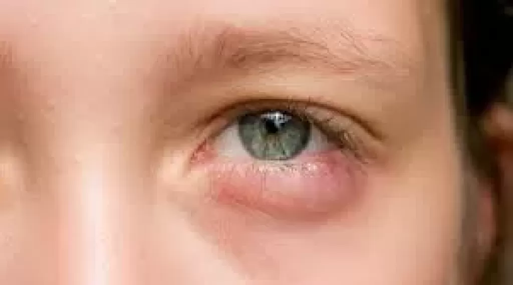 متى يكون انتفاخ العينين دليل على اضطراب الهرمونات؟