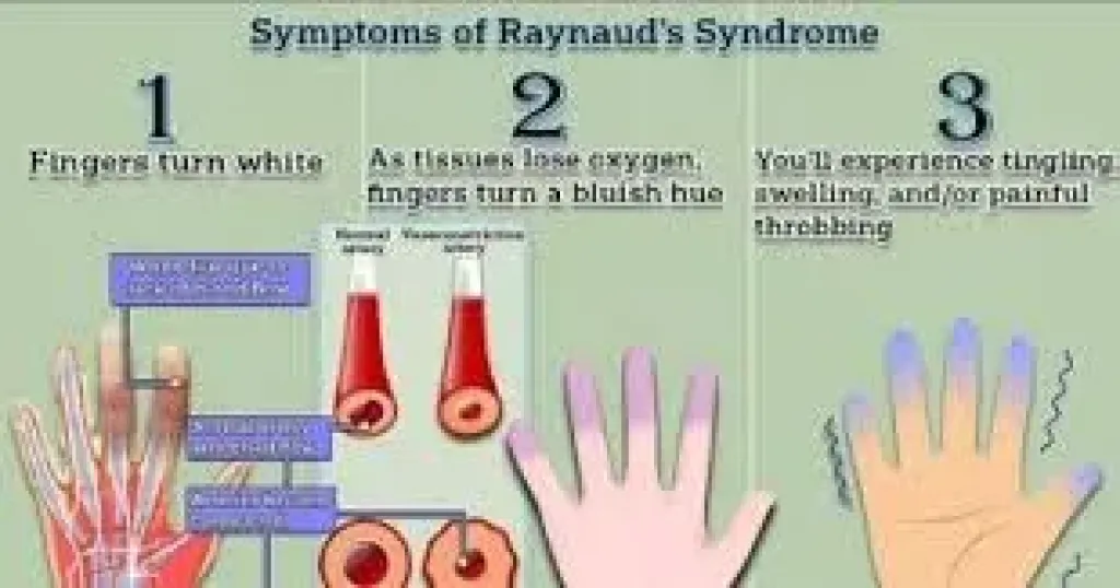 اختبار مدته دقيقة يكشف إذا كنت تعاني من مرض برودة الأطراف ”رينود”
