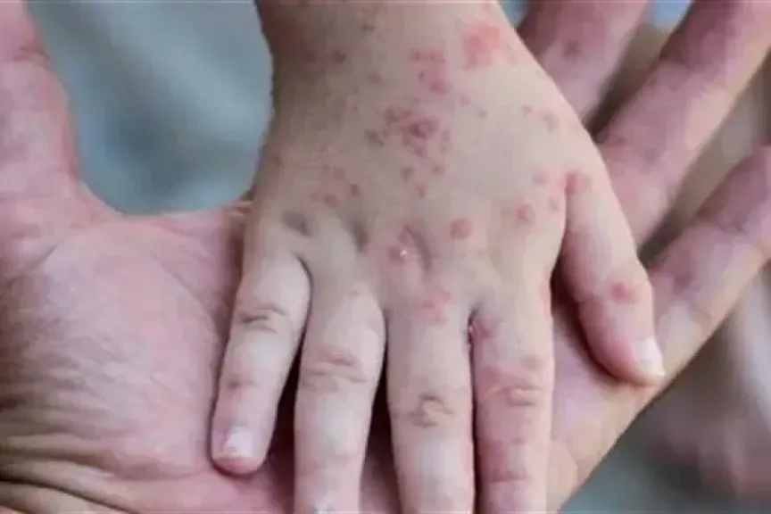 الصحة العالمية تصدر إرشادات جديدة للوقاية من جدرى القرود