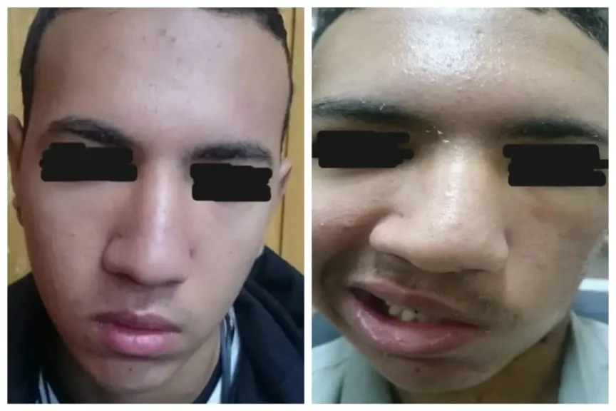 المستشفى الرئيسي بجامعة أسيوط يعيد الأمل لشاب بعد إصابته بطلق ناري نتج عنه شلل بالوجه