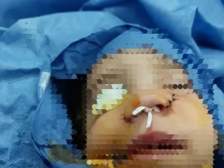 نجاح فريق جراحى بمستشفى قها التخصصى فى إنقاذ أنف طفلة تعرضت لحادث من التشوه