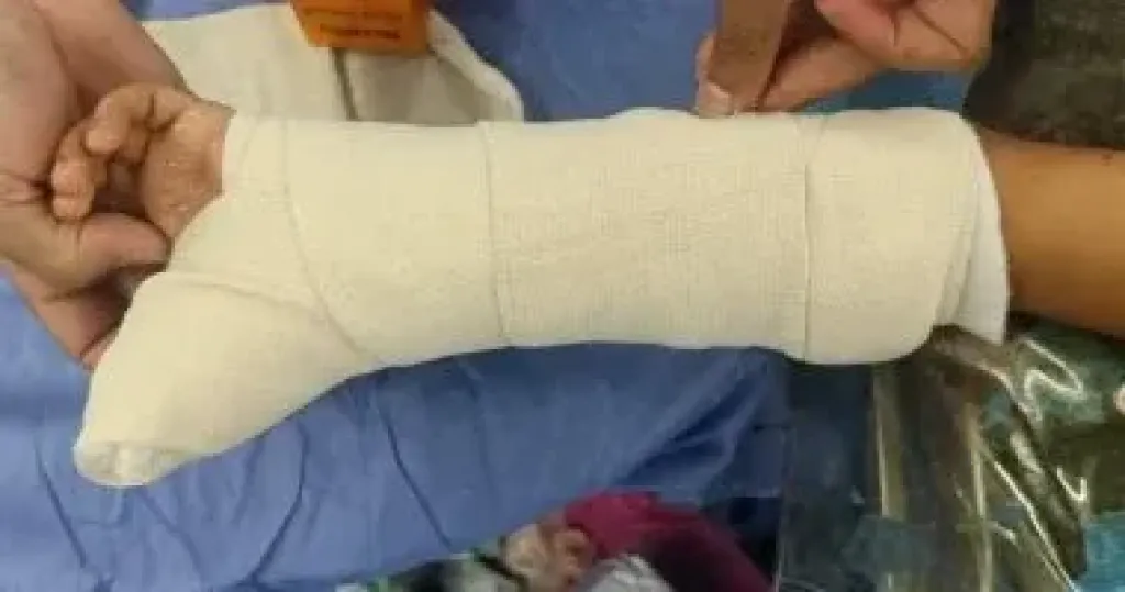 فريق طبي ينقذ طفل من بتر باليد