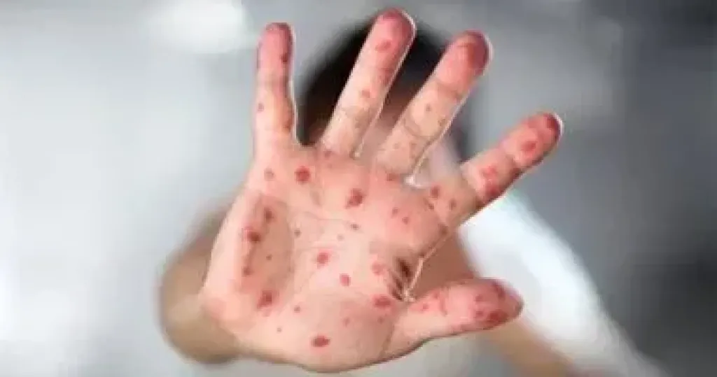 استئناف الدراسة فى فصل حالات الإصابة بفيروس HFMD بالجيزة بعد غد