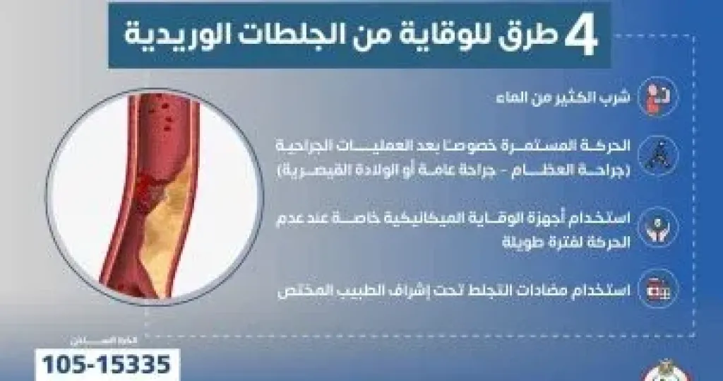 وزارة الصحة توضح 4 طرق للوقاية من الجلطات الوريدية