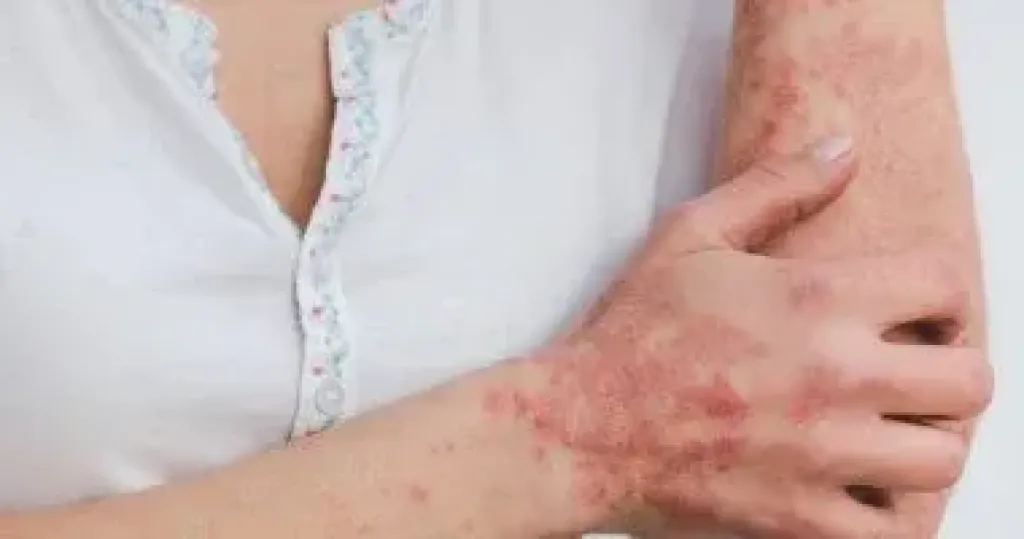 علاجات منزلية تساعد فى التخفيف من حدة أعراض الصدفية علاجات منزلية تساعد فى التخفيف من حدة أعراض الصدفية