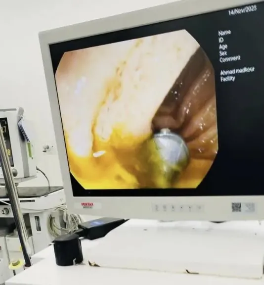 إنقاذ حياة طفل ابتلع مسمارًا بمجمع الشفاء الطبى فى بورسعيد