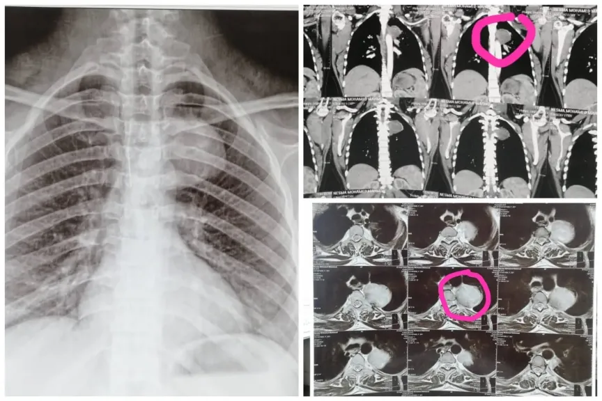 مستشفيات جامعة أسيوط تعلن عن نجاح فريق طبي بقسمي جراحة المخ