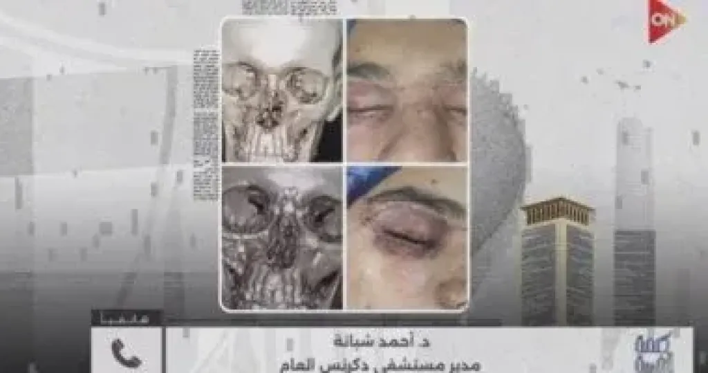 نجاح عملية جراحية دقيقة بمستشفى دكرنس العام بقيادة فريق متخصص