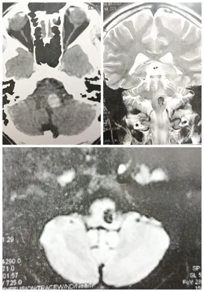 طبي بقسم جراحة المخ والأعصاب بجامعة أسيوط يتمكن من استئصال ”وحمة دموية