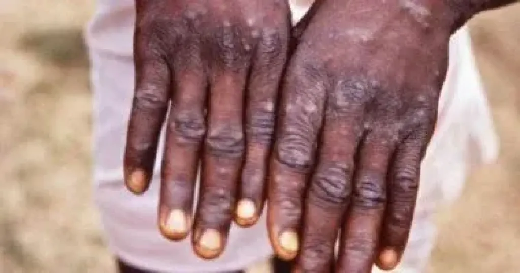 روسيا تعلن تسجيل إصابتين بجدرى القردة بين عائدين من الخارج