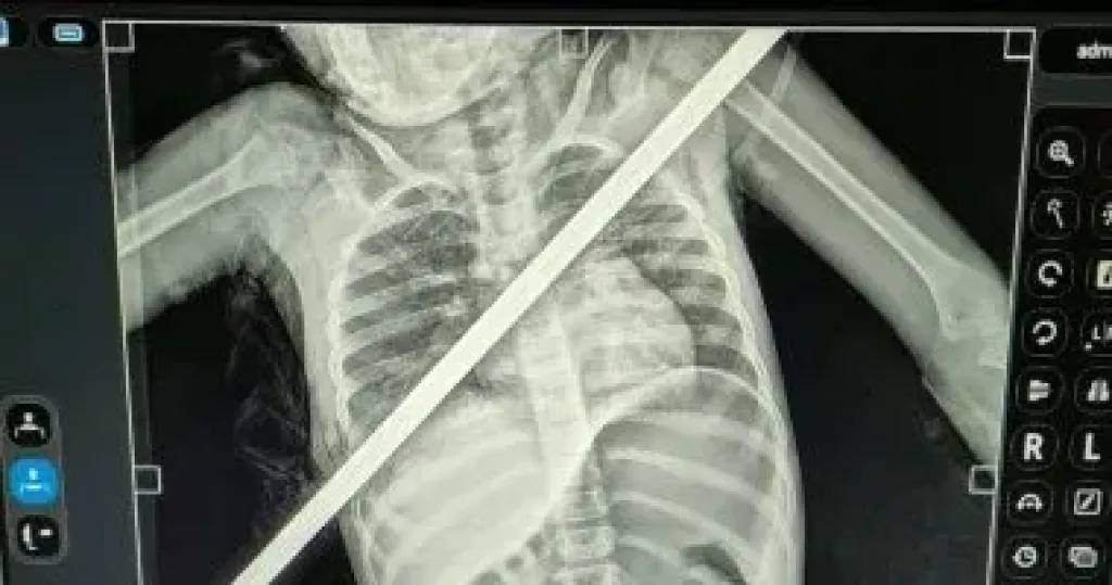 3 ساعات فى العمليات.. إنقاذ حياة طفلة اخترق سيخ حديد صدرها فى بنها الجامعى
